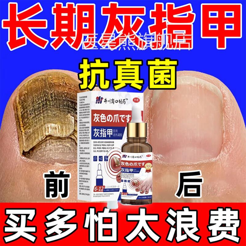 治旗严重灰指甲专用正品官方舰店疗真菌感染脚气抑菌止痒日本脱甲