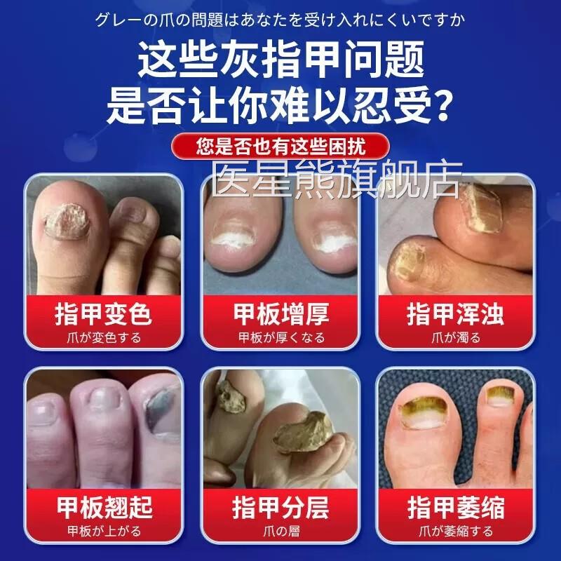 灰指甲日本进口技术水灰趾甲修复脱增厚空甲甲一滴正品抑菌净液QT