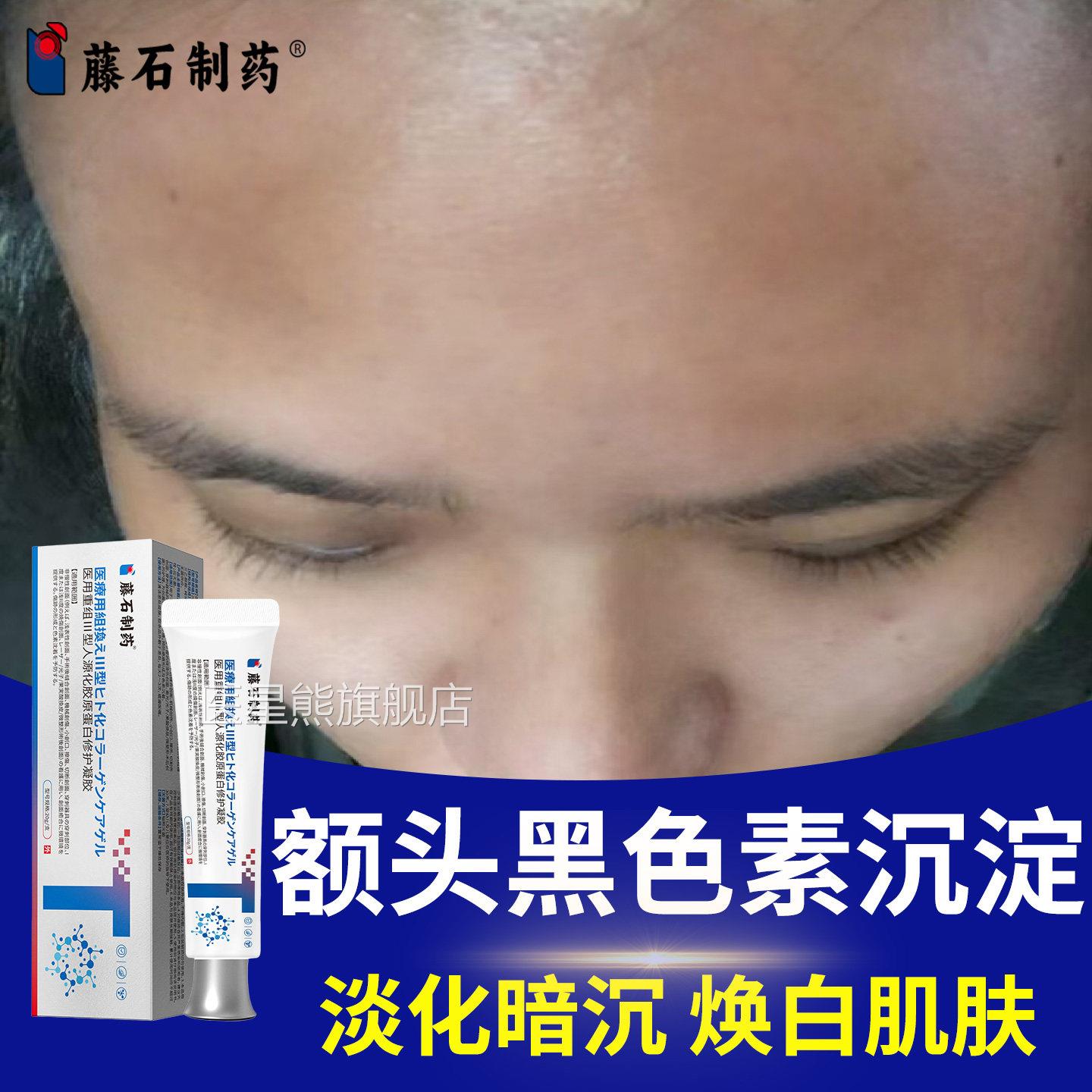 额头黑色素沉淀去除药膏去淡化黄脸上黑斑祛痘印疤痕医用美白膏CA