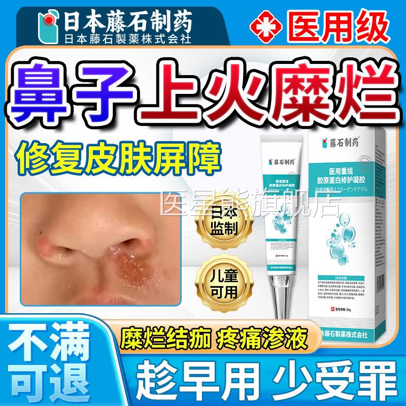 鼻子上火起泡红肿干燥生疮子长痘肿疼痛痒单纯疱疹膏药监备案红OM