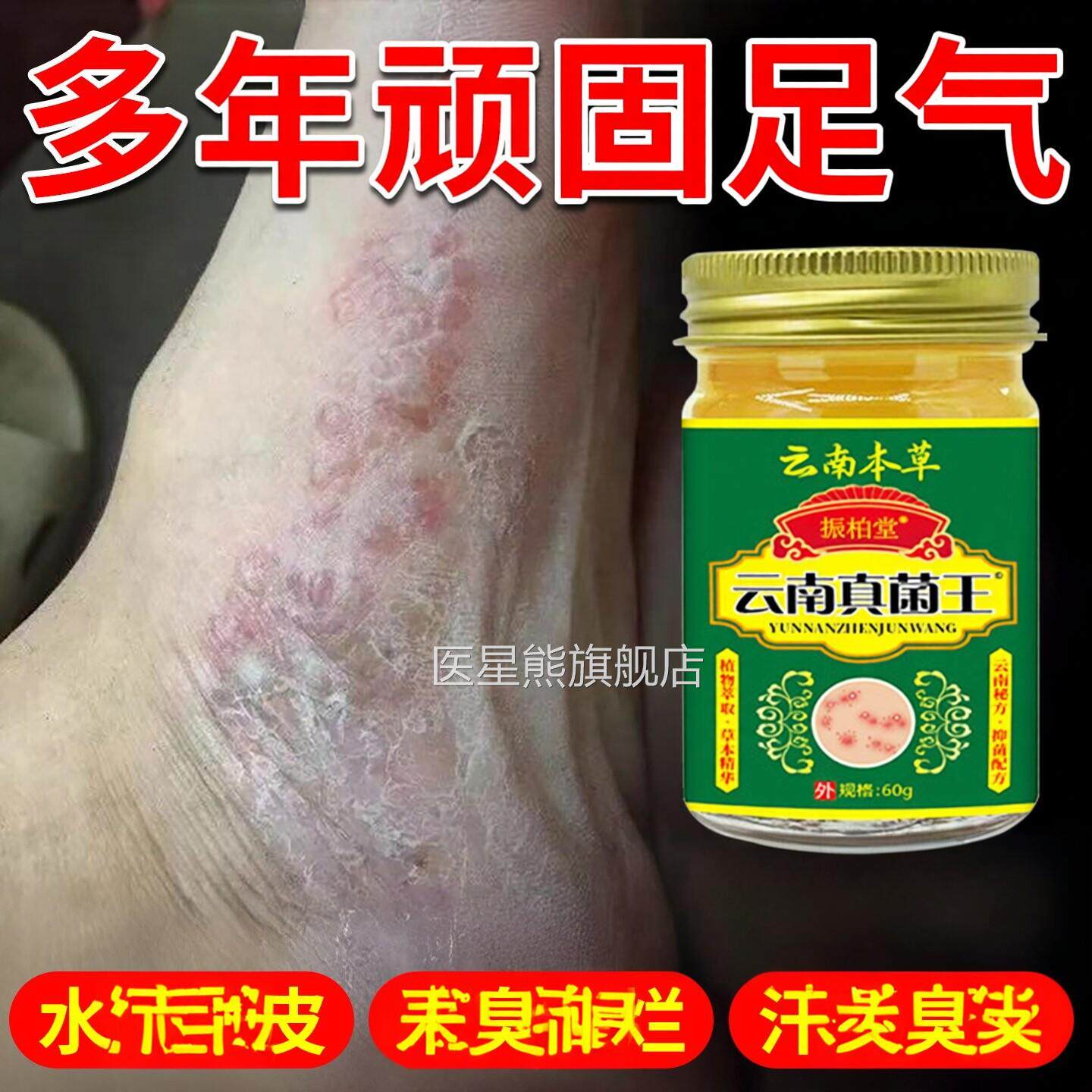 云南真菌王足气脱皮足痒足臭足缝痒烂皮足膏防止水泡足脱足趾臭膏