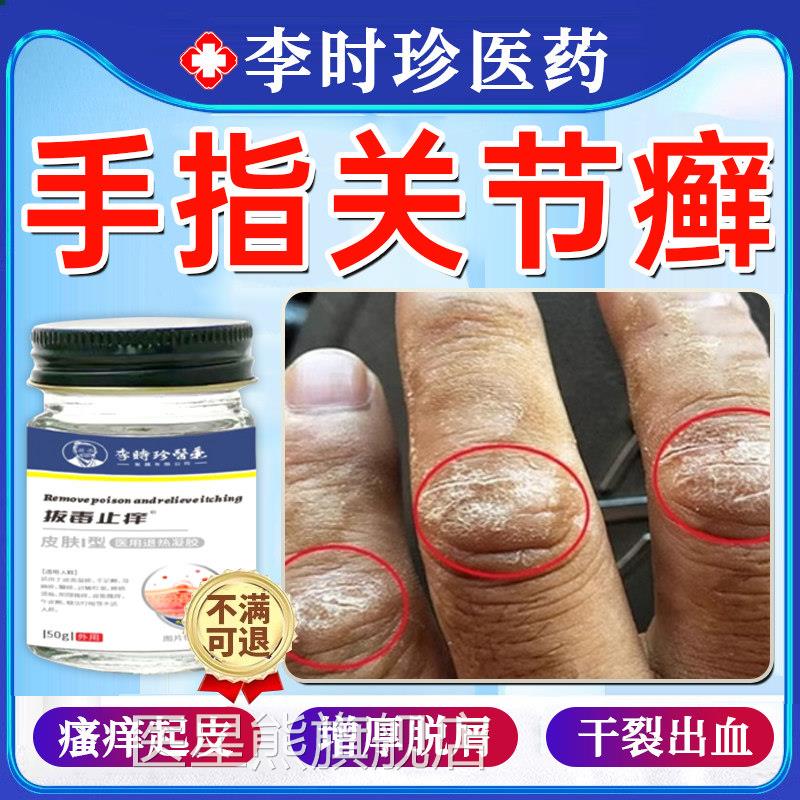 手关节癣手指癣膏脱皮干 干裂真菌感染毒癣康湿疹疱疹止痒药膏正