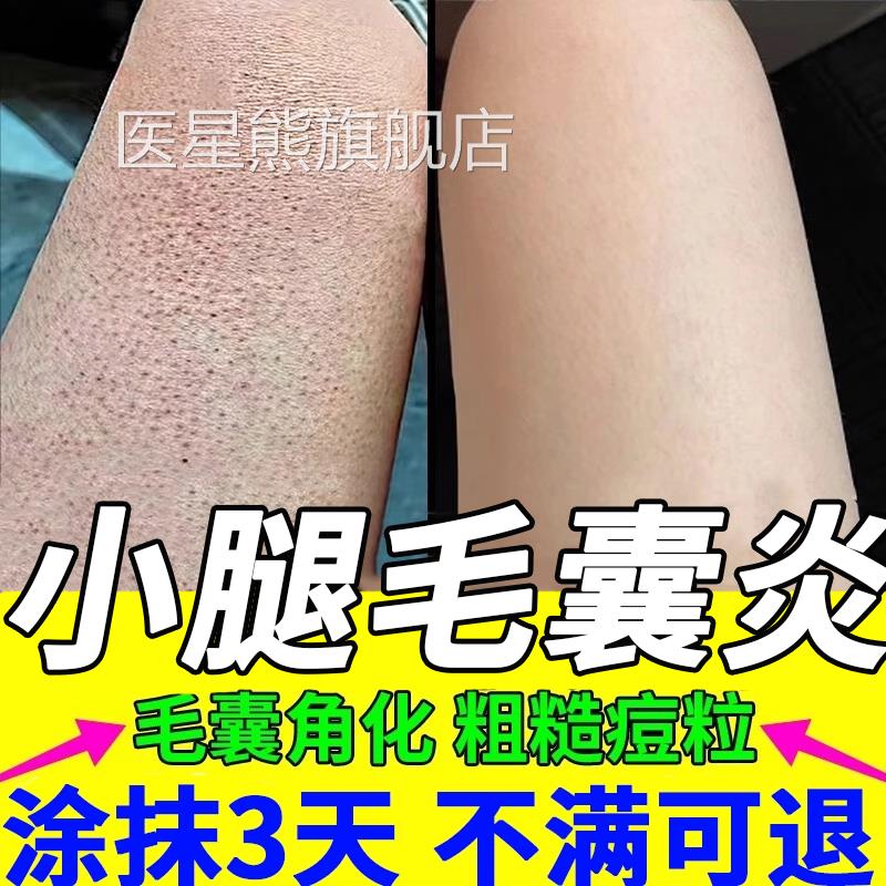 鸡皮肤疙瘩囊角化症专用膏药去除全身手臂腿神器胳膊小颗粒疙毛瘩