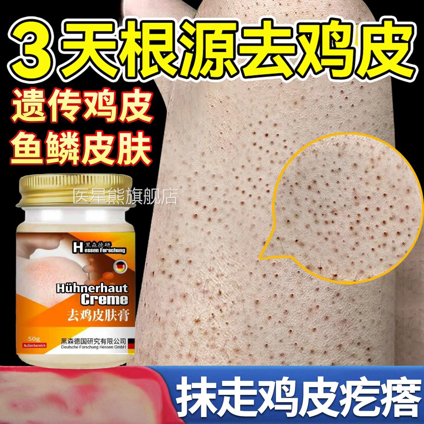 日本鸡皮肤疙瘩毛囊角化症用膏去除全身手臂胳膊干燥起皮腿神器医