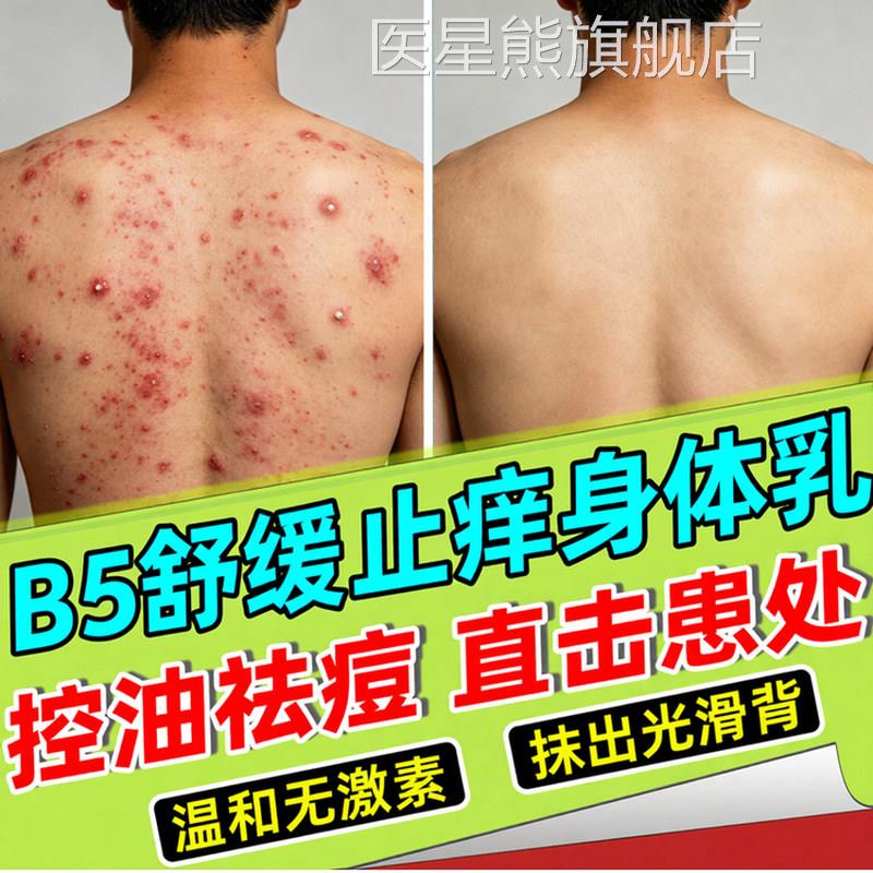 马拉色菌前胸后背部痘过氧祛化苯甲酰身体乳粉末黑印涂抹身体乳膏
