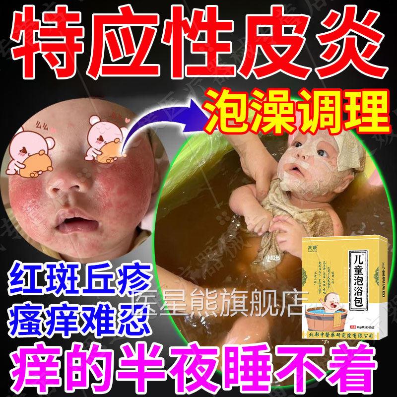 儿童特应性皮炎止痒去身体乳根皮瘙痒特异性宝宝湿疹泡澡肤包CA医