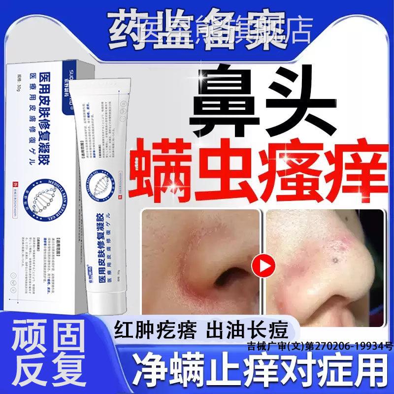 鼻子去螨B虫脸部药监备案膏脸上清洁酒糟鼻头毛囊炎祛痘面部除螨D