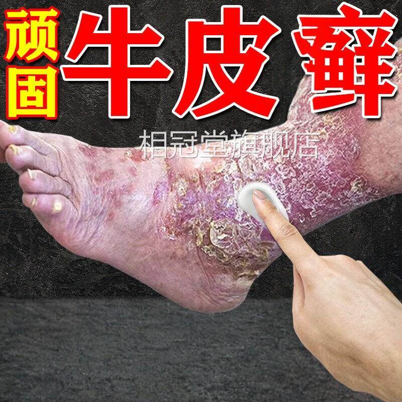 日本进口疗顽固性皮牛银屑效用膏药皮肤真菌感染杀菌相冠堂旗舰店