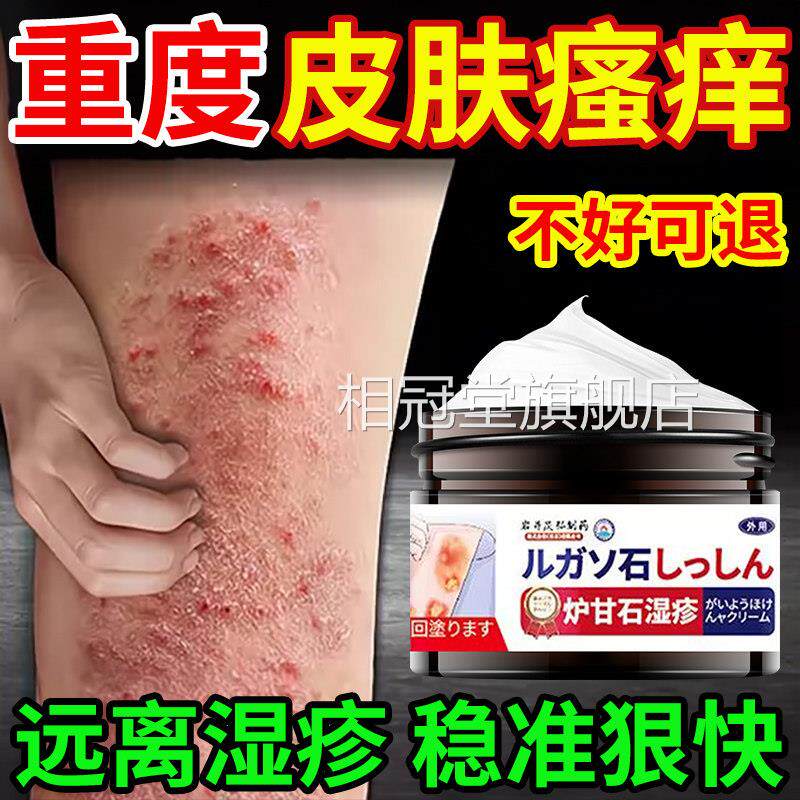 皮肤止湿疹痒膏去外用顽固皮炎阴囊肛瘙痒根顽固汗周疱疹牛皮股癣