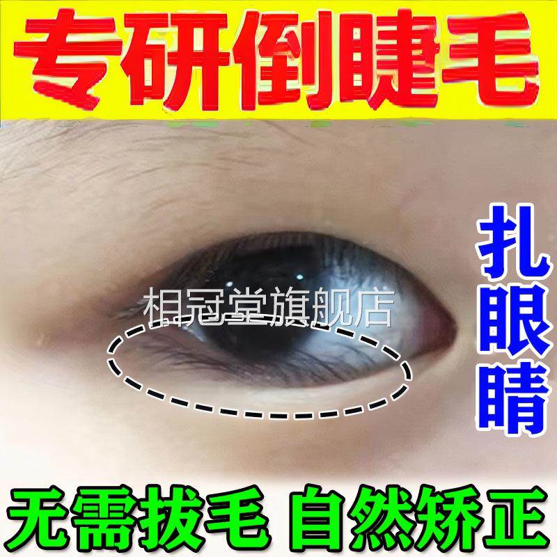 倒睫毛矫正贴人成婴儿睫毛倒长眼睑下垂提拉眼皮儿童专用神器正品