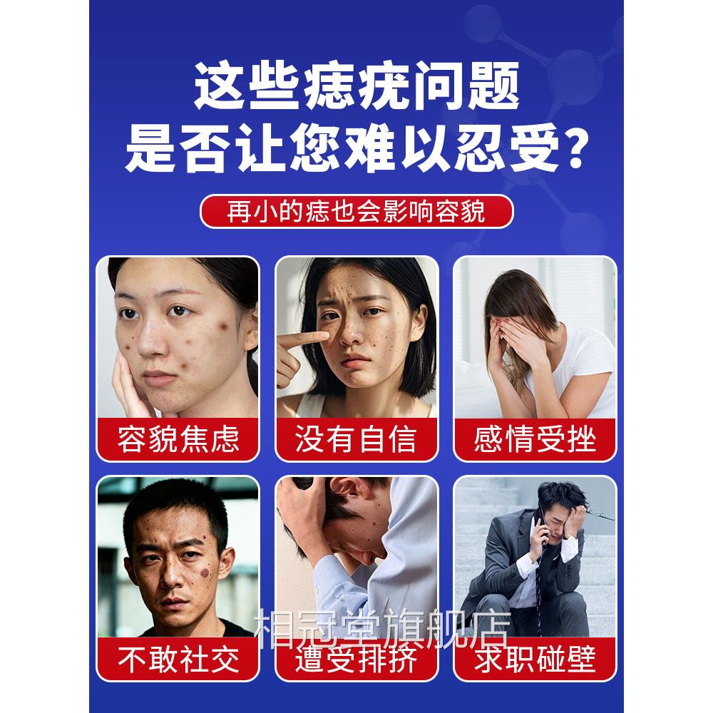 点痣膏正品点痣疤水无痕神器不留修复液祛去痣官方大药房旗舰店nj