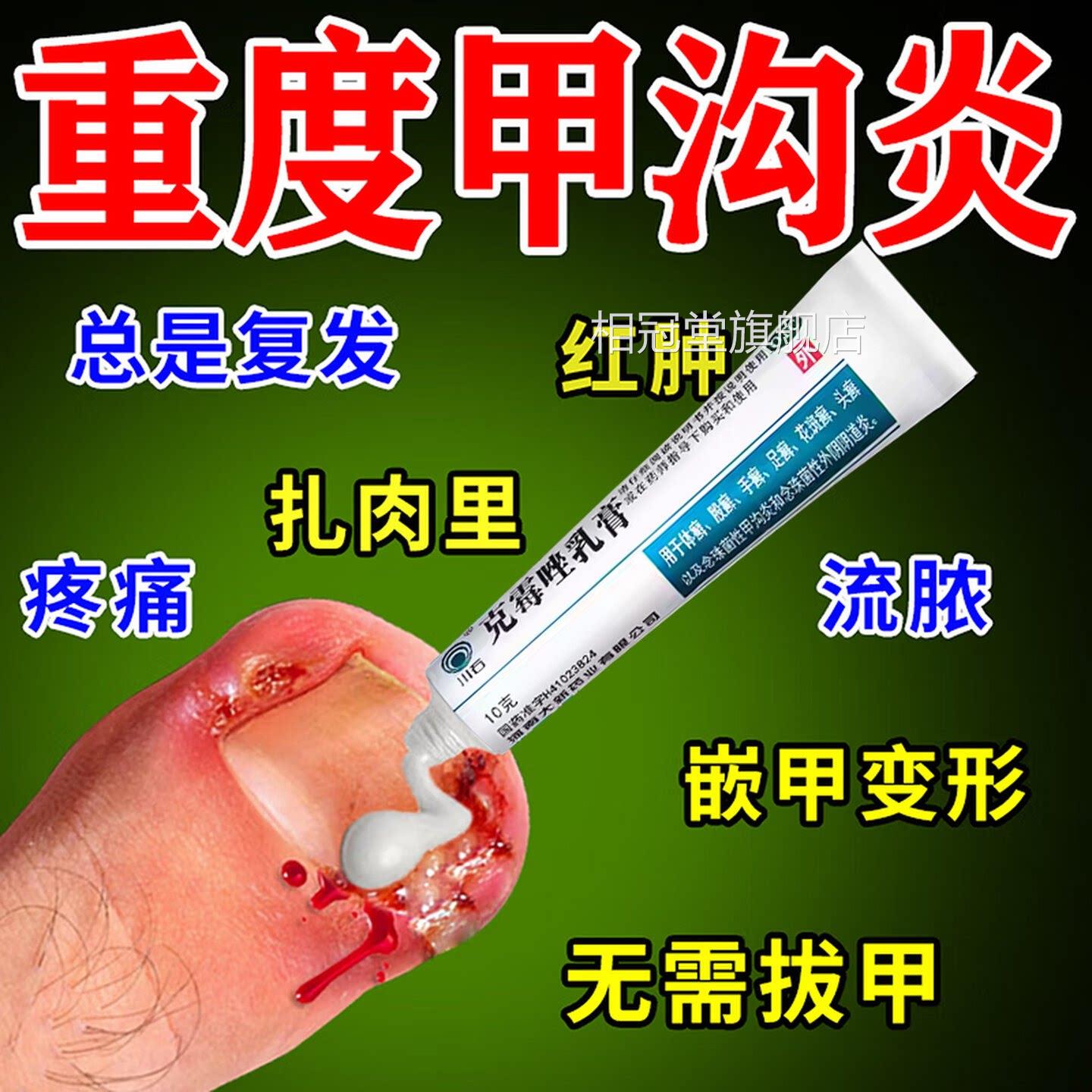 手脚大拇指沟炎治疗专用药膏水息肉去除脚趾甲往肉里长非特效甲QF