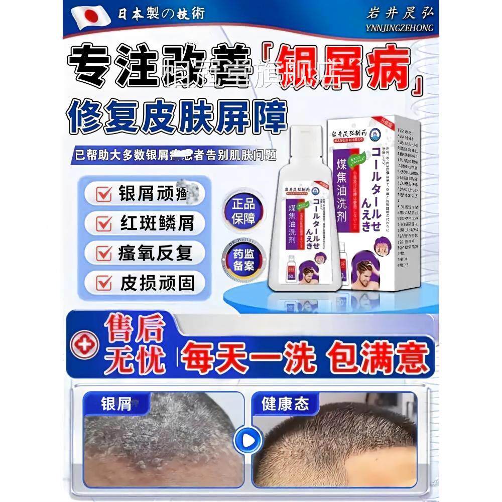 银屑病用专洗溢水发头皮煤焦油鲜洗剂效特非药膏真菌感染皮脂性皮