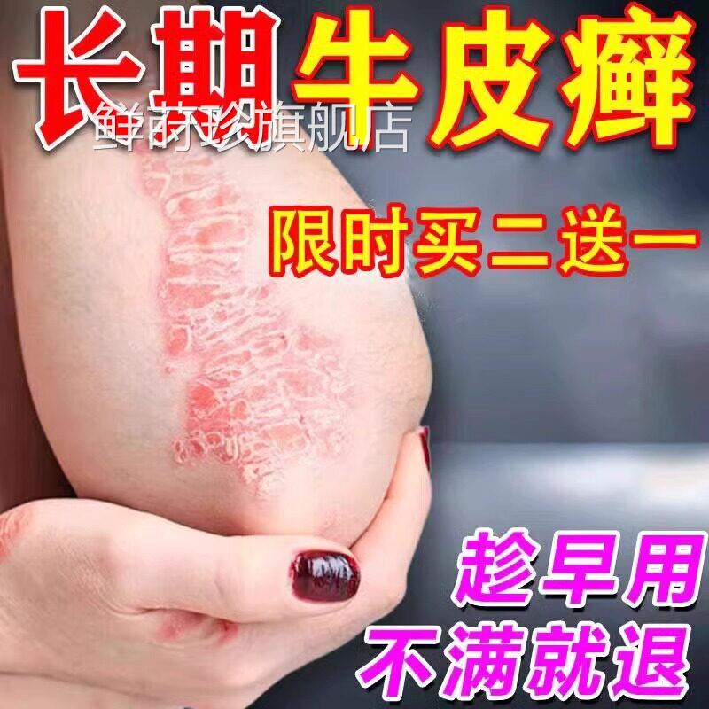 牛皮癣脚气藓贴膏软头皮手足银病屑皮肤止痒湿疹脚臭真菌凝胶鲜莳