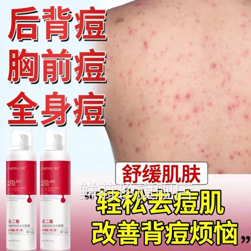 粒消背上长痘痘毛囊背炎除螨祛痘痒喷雾剂背后背前胸胳膊手臂上痒