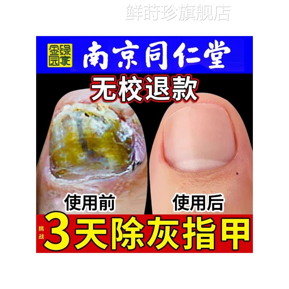疗治灰指甲用专抑菌液脱甲抗菌治效特根一滴净亮旗舰店正品甲药水