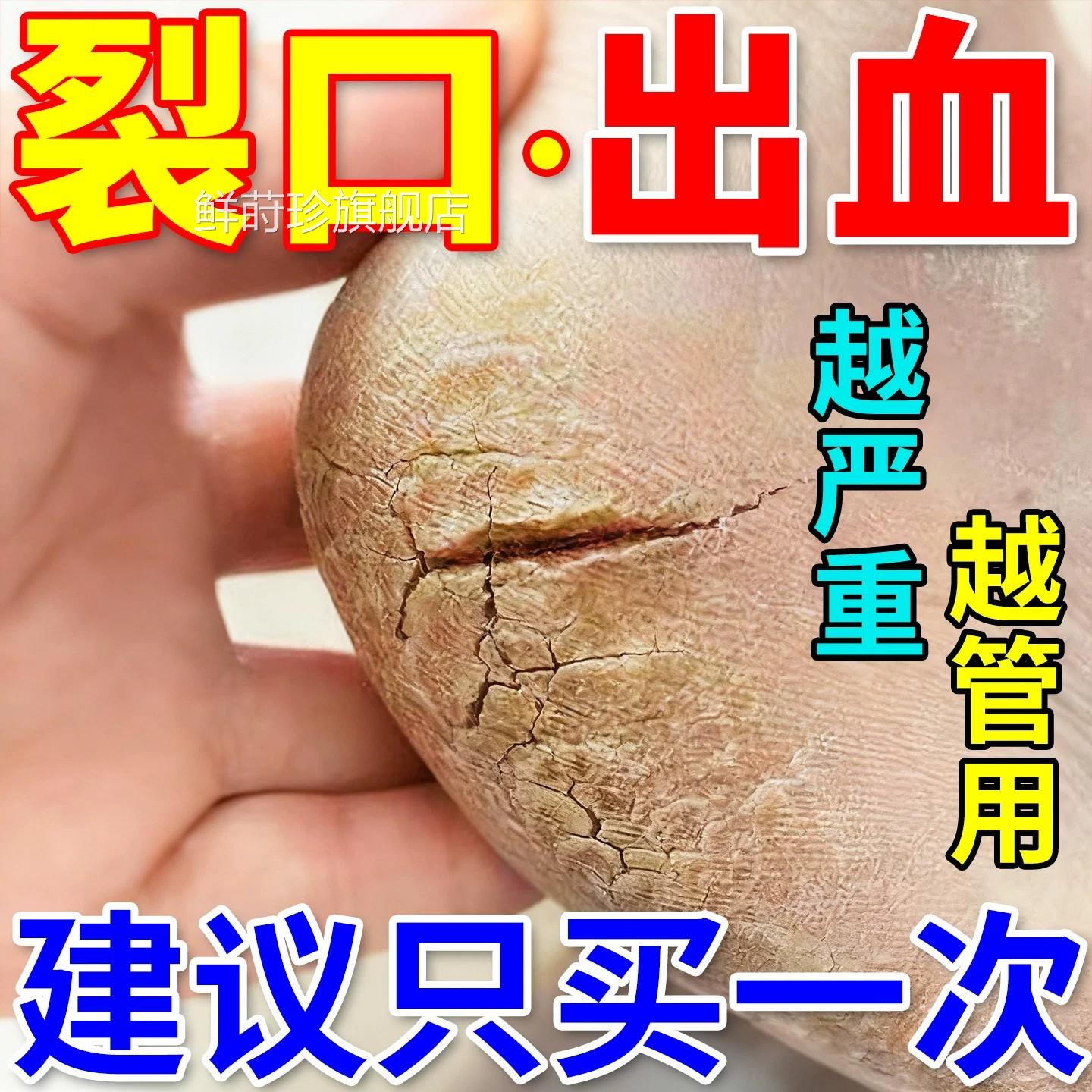 日本脚后跟干裂修复霜滋润脚底裂脱皮起硬皮防护手足开裂口皲裂膏