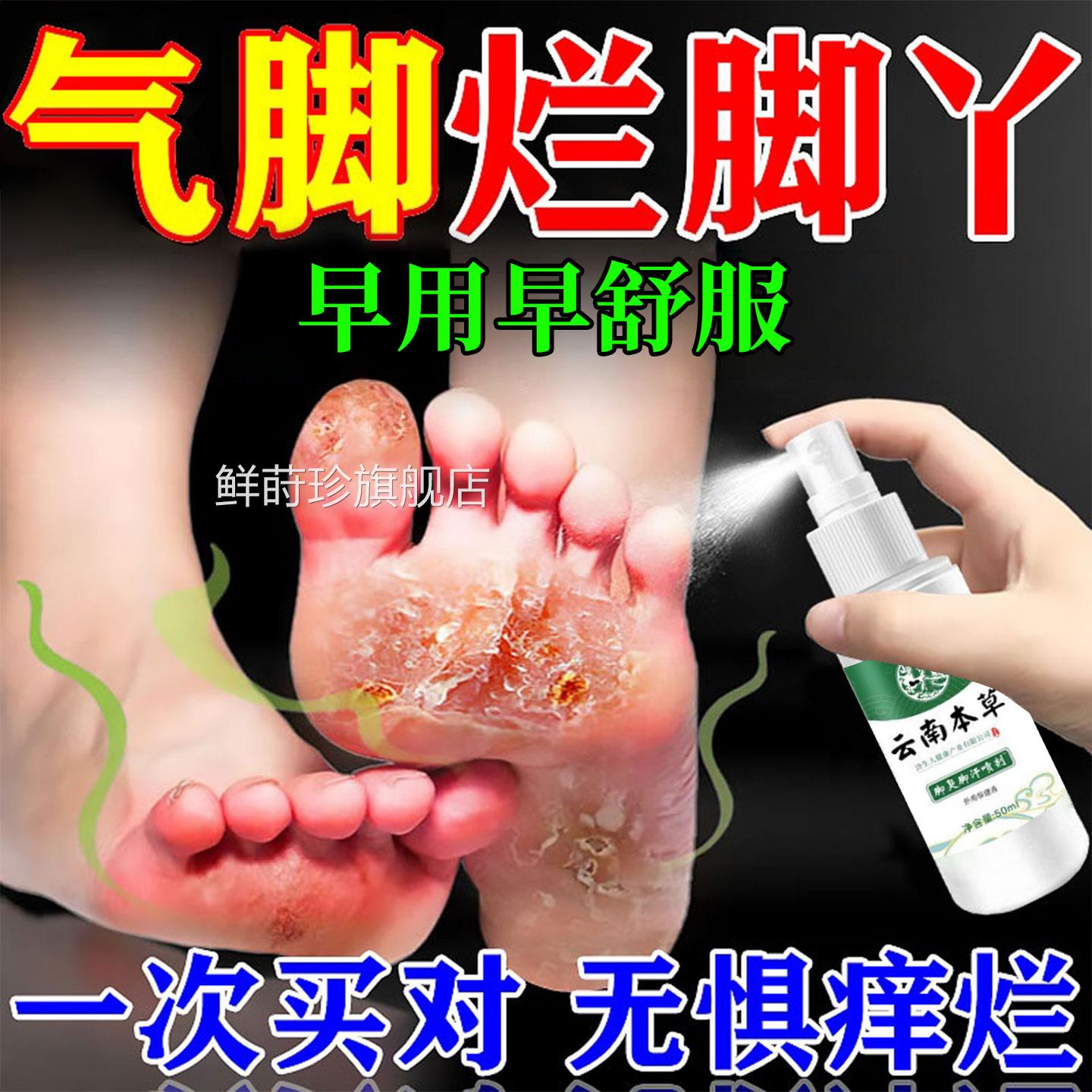 云南本气脚喷剂止痒根脱皮抑菌水泡烂脚香港脚糜烂草专脚趾缝痒用