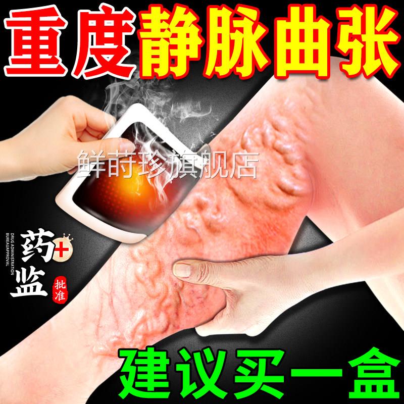 祥草医静脉曲张穴位贴曲张理疗贴炫蚯蚓胀腿青筋凸起肿缓解%正品
