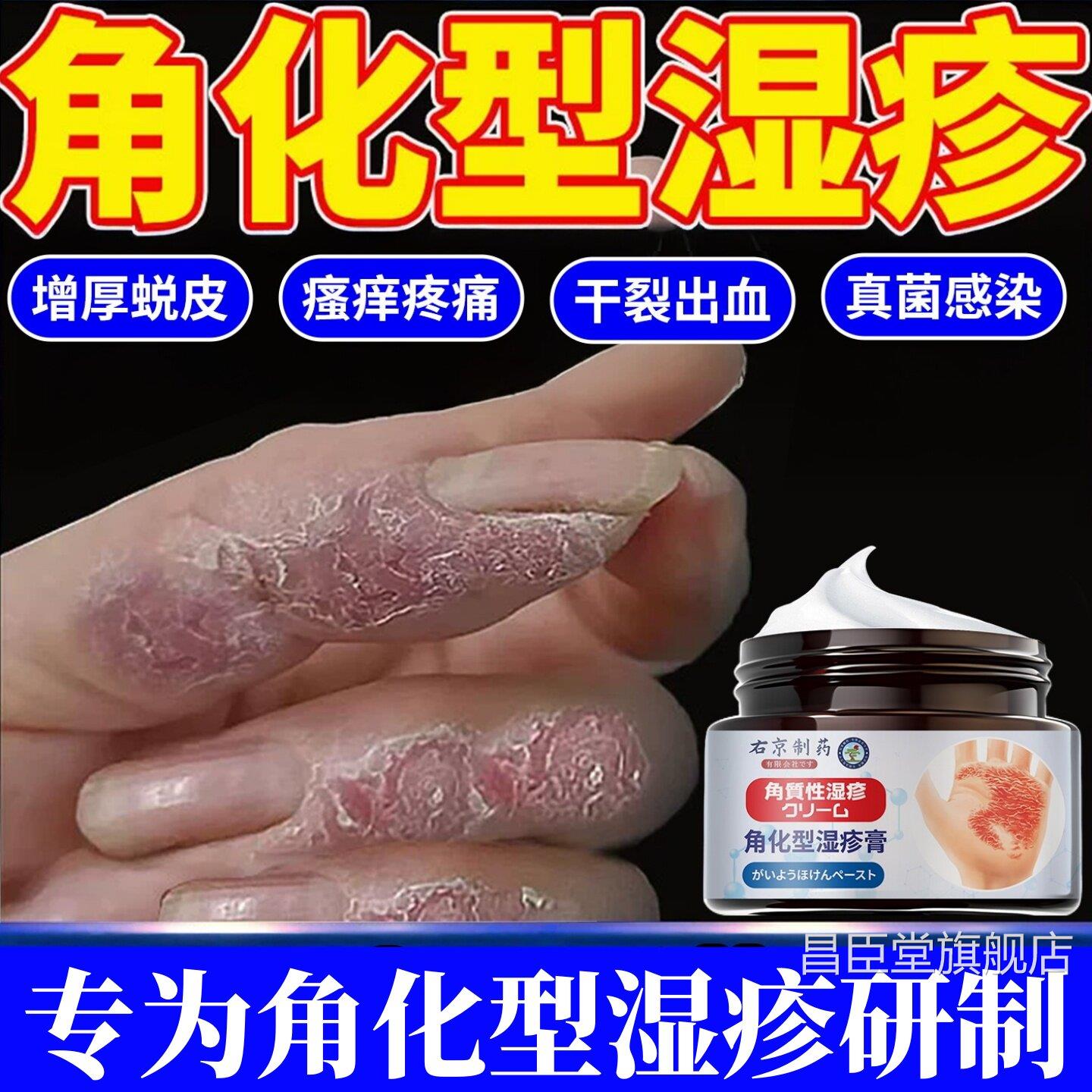 角化皮型湿疹手部脱干真裂菌感染止专用痒手足癣去手脚止根部痒膏