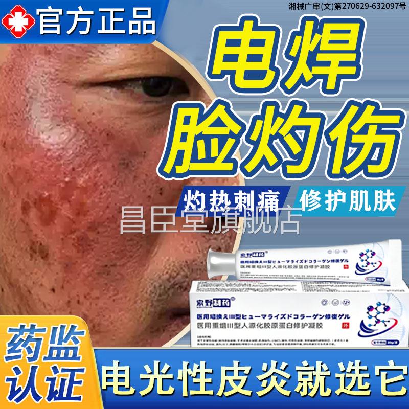 焊烤脸修复脸部电灼伤发红干燥脱皮专用电弧烧伤药房同款烫伤膏BD