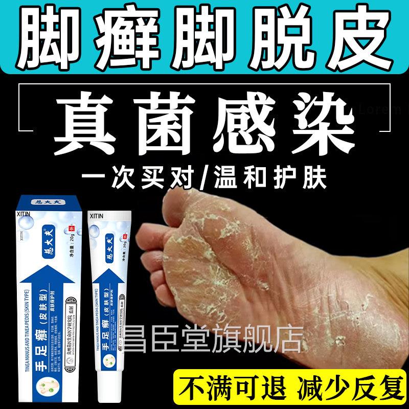 角化型足癣脚癣止一次净官方旗舰店脚脱皮干裂真菌感染贵州神奇UU