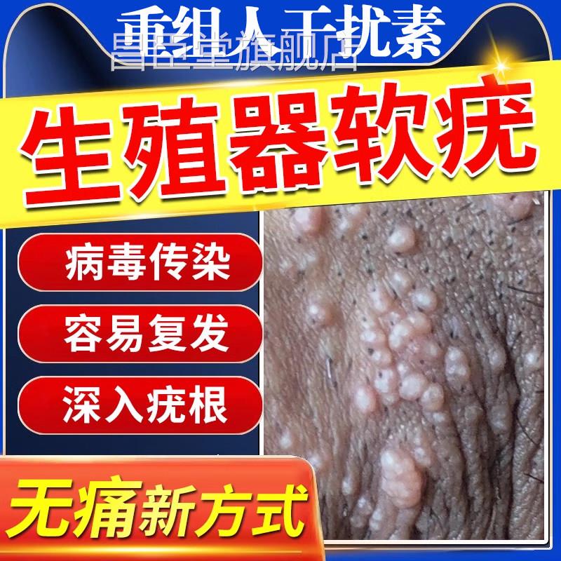 传染性软疣软尤去疣膏扁平疣病毒肉除小粒重组人干扰素a2d软膏rr