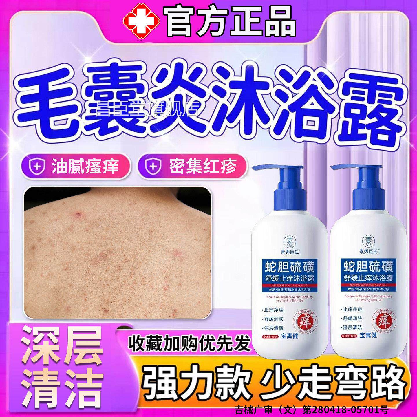 前胸痘后背毛囊炎去除背上长痘沐浴露马拉色菌除螨祛痘痒手臂疙瘩