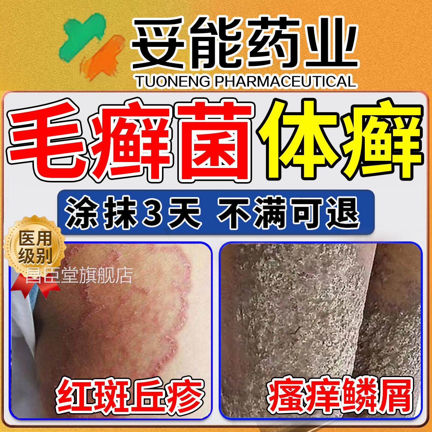 儿童体癣去癣药膏股藓大腿内侧治感疗红色毛癣菌真菌染成人昌臣堂