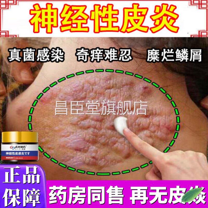 神经性皮炎肤特药效根去外用膏治除皮病癣藓湿疹真菌感染顽固疗30