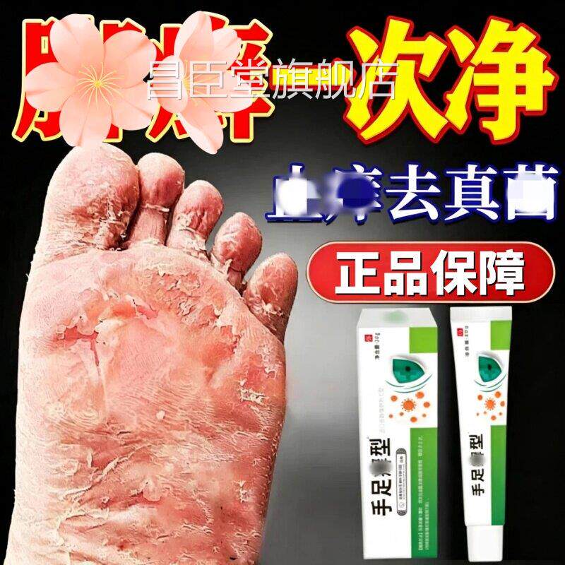 角化足型鲜藓一次净官方脚旗舰店脚干裂脱真皮菌感贵州止染神奇痒
