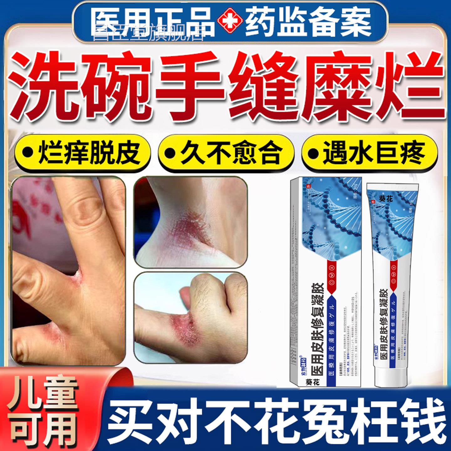 碗洗碰水手指缝溃烂药膏烂手丫糜烂痒水泡开裂脱皮湿疹软膏TK昌臣