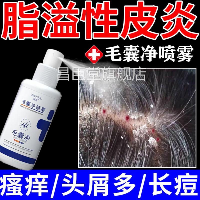 脂溢性皮炎头部喷剂止头屑头痒专用真痒菌感染头皮癣毛囊炎喷雾LL