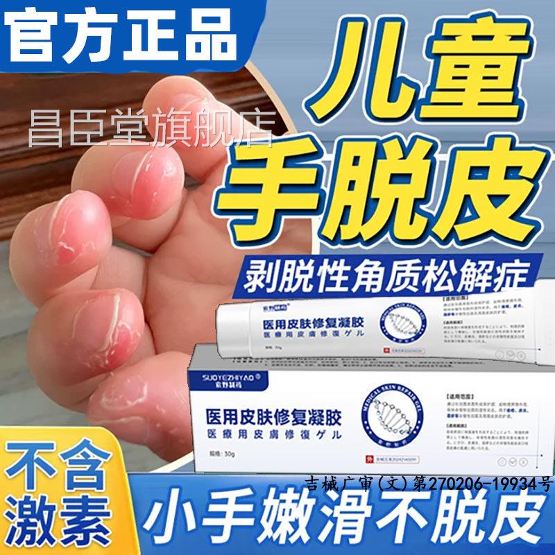 剥性角质松懈症儿童手指脱皮小孩手脱严重专用真菌蜕皮干燥起皮BD