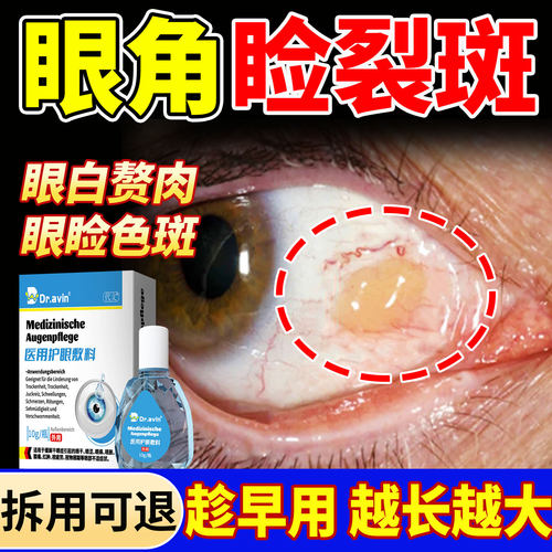 眼角眼睑裂斑【越长越大】