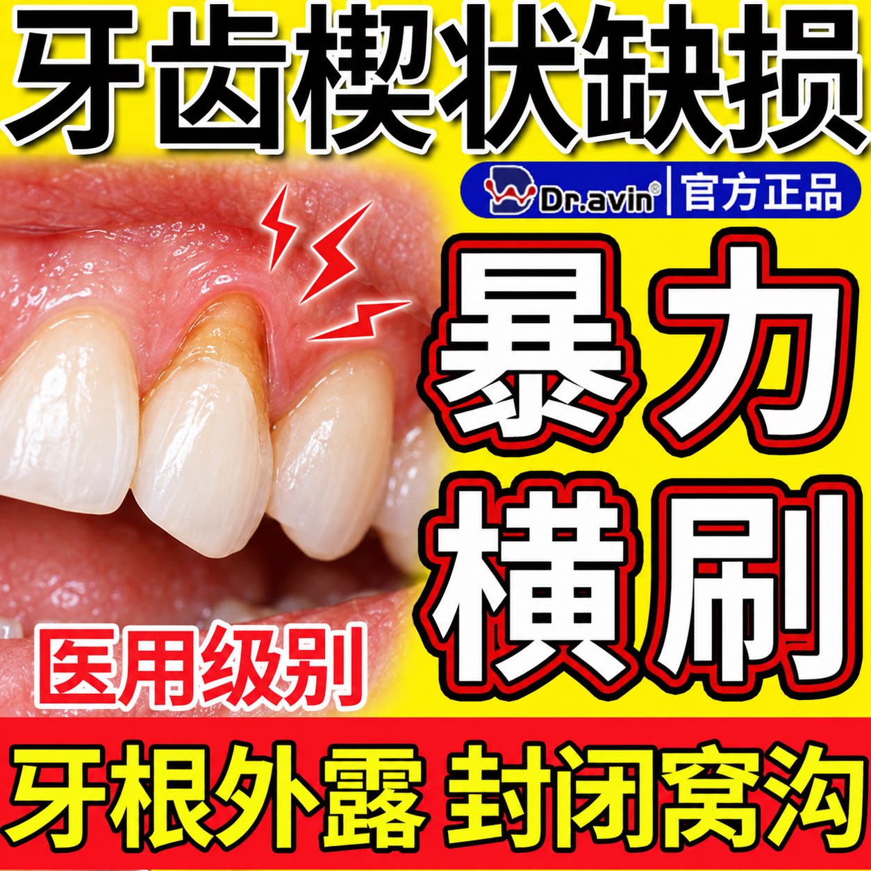 牙根牙齿漏根烂洞契楔状缺损牙釉质修补修护修复液凝胶可搭牙膏CS