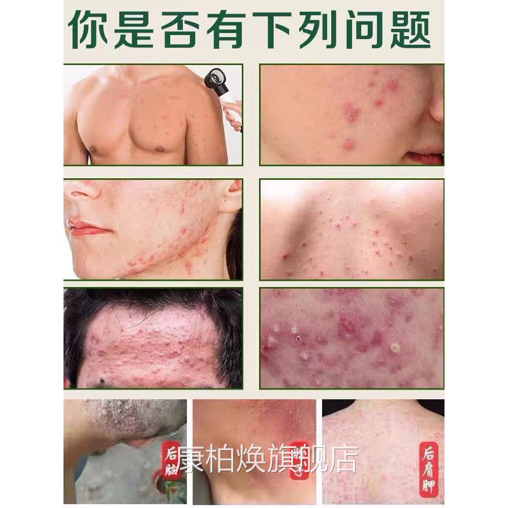 马拉色膏头皮膏 药头上菌脖子前胸后背疙瘩痘痘糠秕孢子真 菌康柏