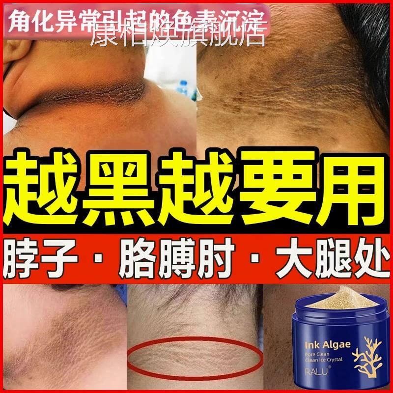 去脖子黑素色素去除黑棘皮后脖子去除颈部黑色沉淀洗不干净清洁膏