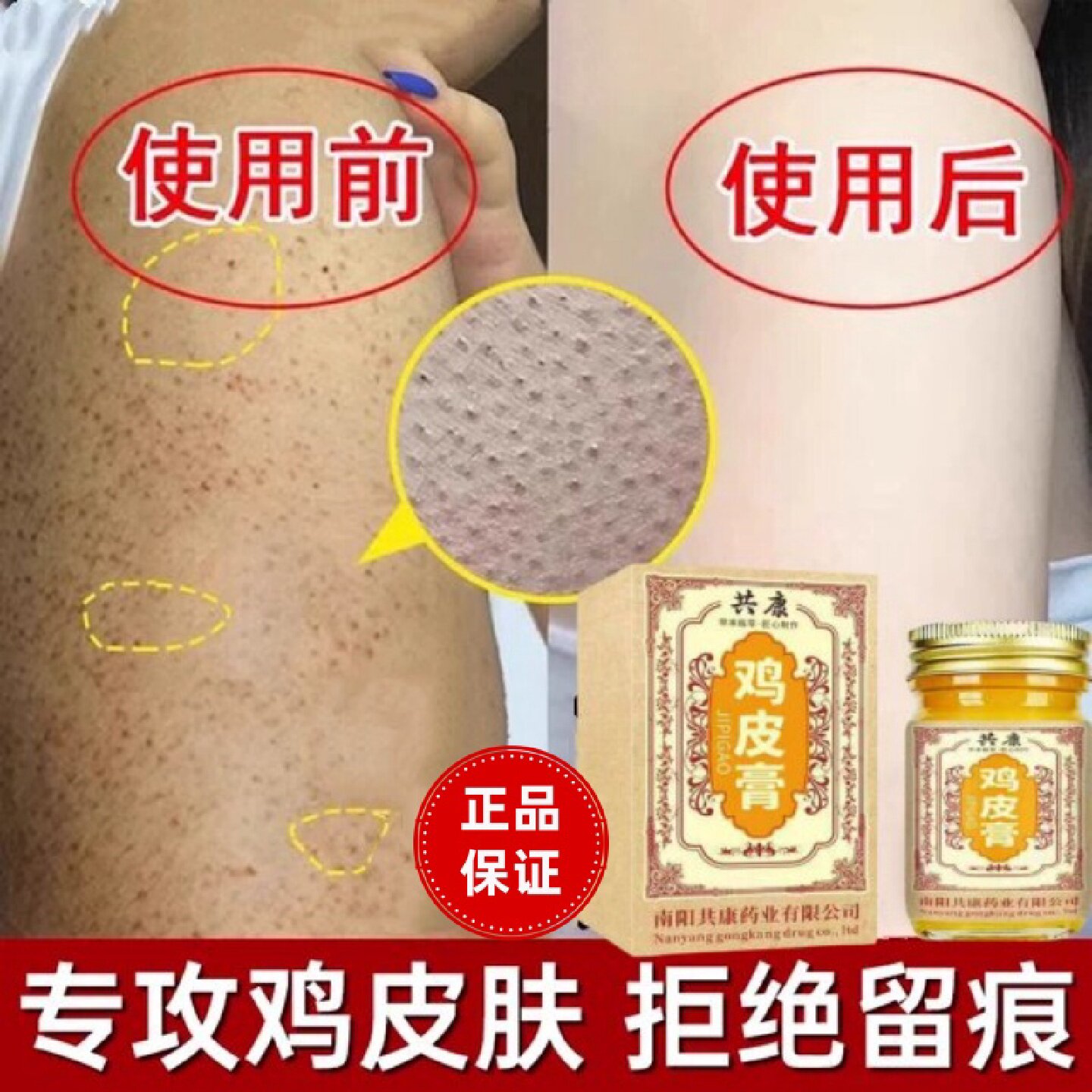 鸡皮肤疙瘩毛囊角化症去除神器全身手臂腿专改善胳膊上长疙瘩旗舰