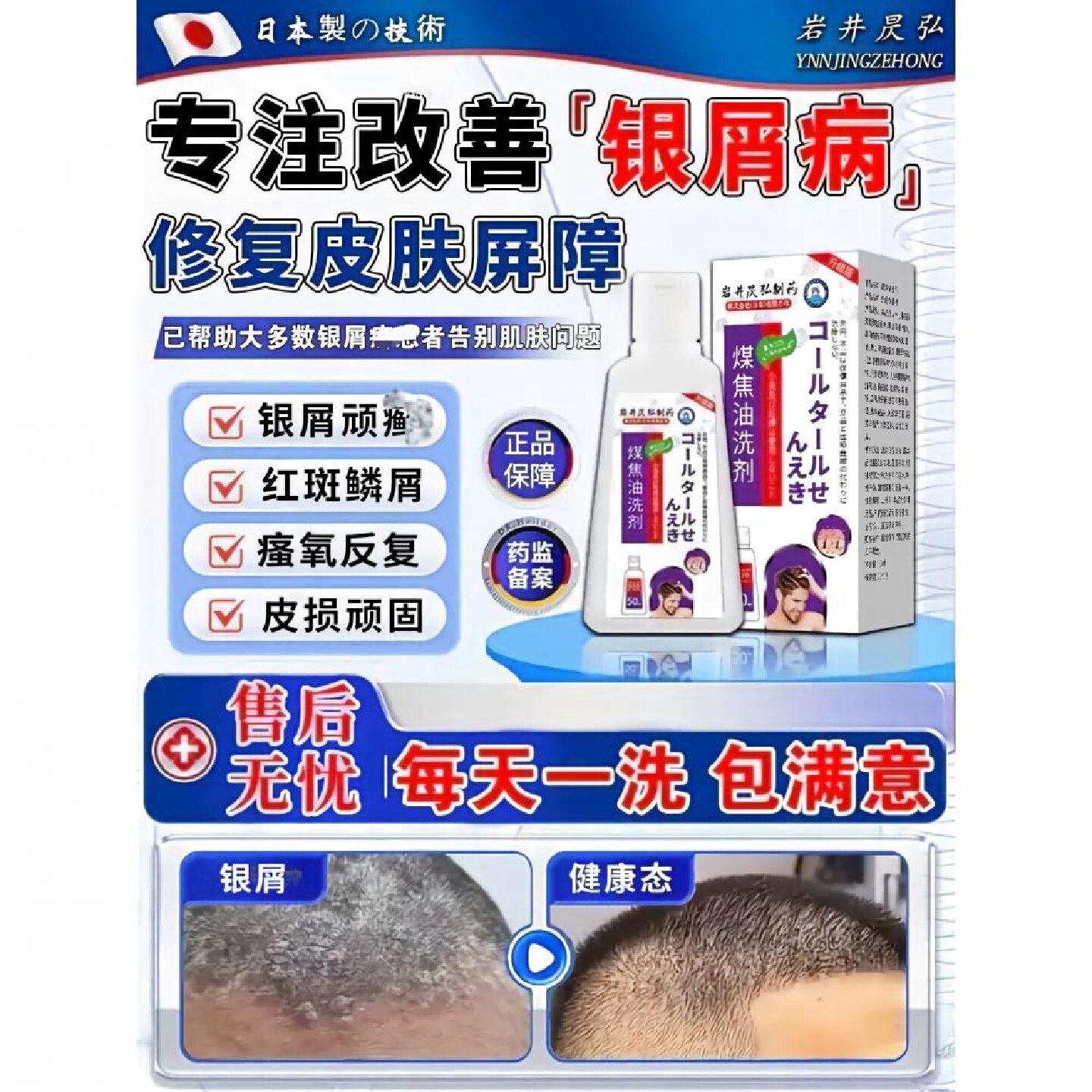 银屑病用专洗水发头皮煤焦油鲜洗剂效特非药膏真菌感染皮脂溢旗舰