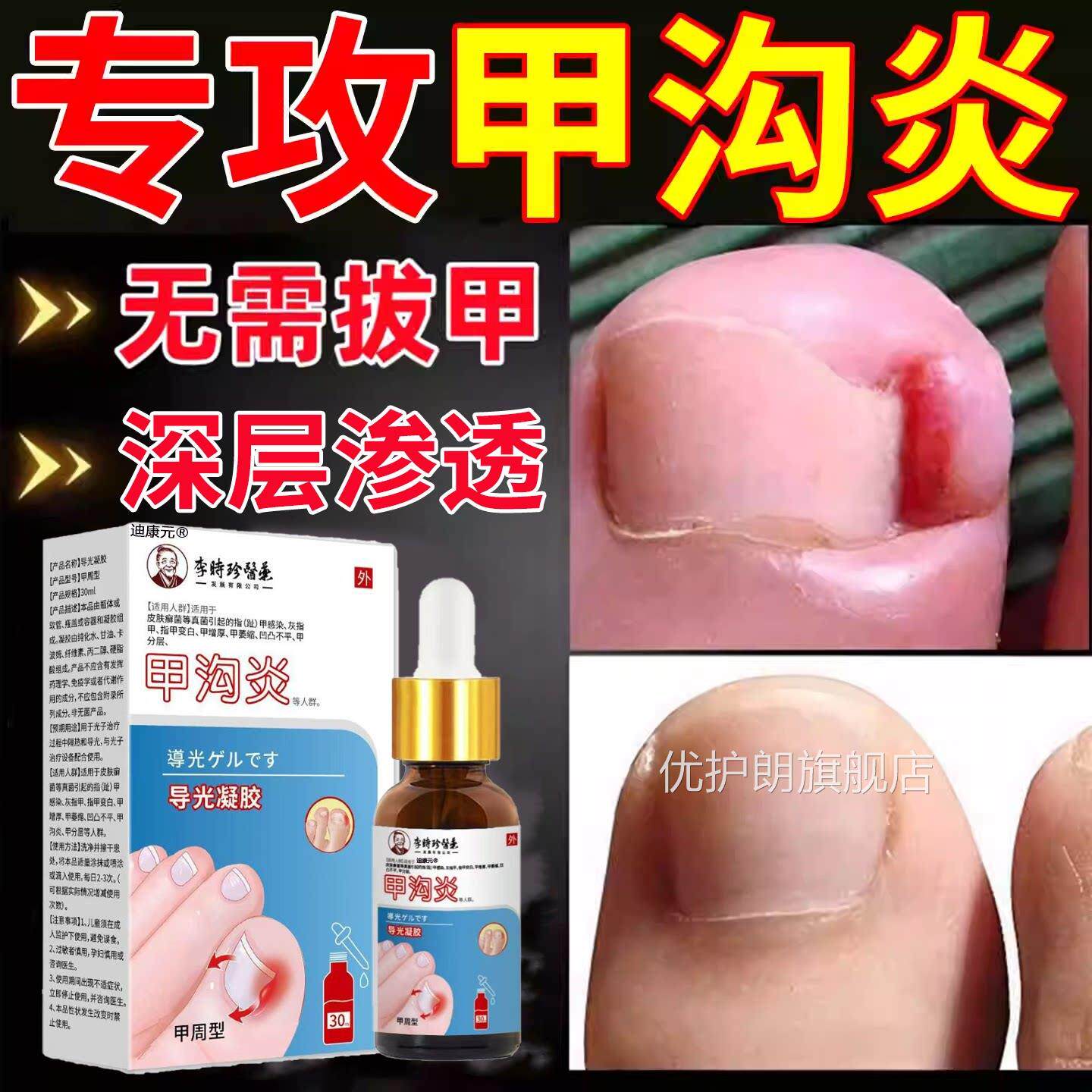 甲沟炎治专疗用特膏效脚大去拇指肉芽息肉除神器嵌甲扎肉软化剂优