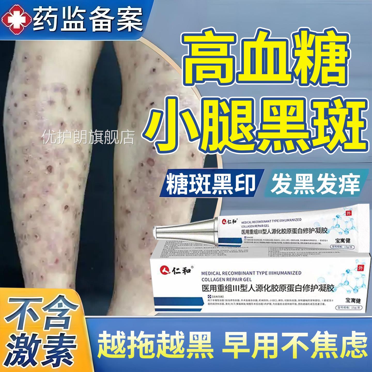 糖尿病痕印引起小腿黑斑去胫前除腿上疤糖斑皮肤痒色素沉着烂足膏