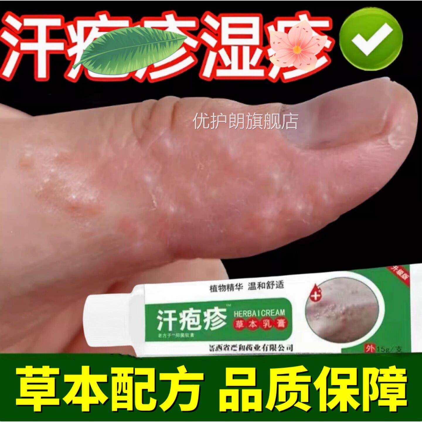 汗止泡疱疹膏专手上起小水泡孢疹用软膏汗状真菌痒感染汗泡疹膏15