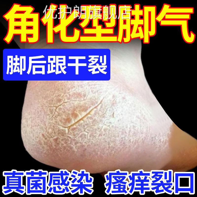 云南真菌王官正品旗舰店脚后跟手足脱皮开裂粗糙方止抑痒菌护理膏