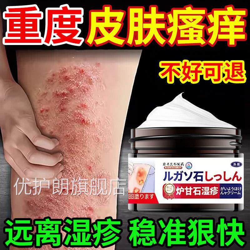 皮肤湿疹止痒膏阴去外用顽固皮炎囊肛周瘙痒根顽固汗疱疹牛皮股癣