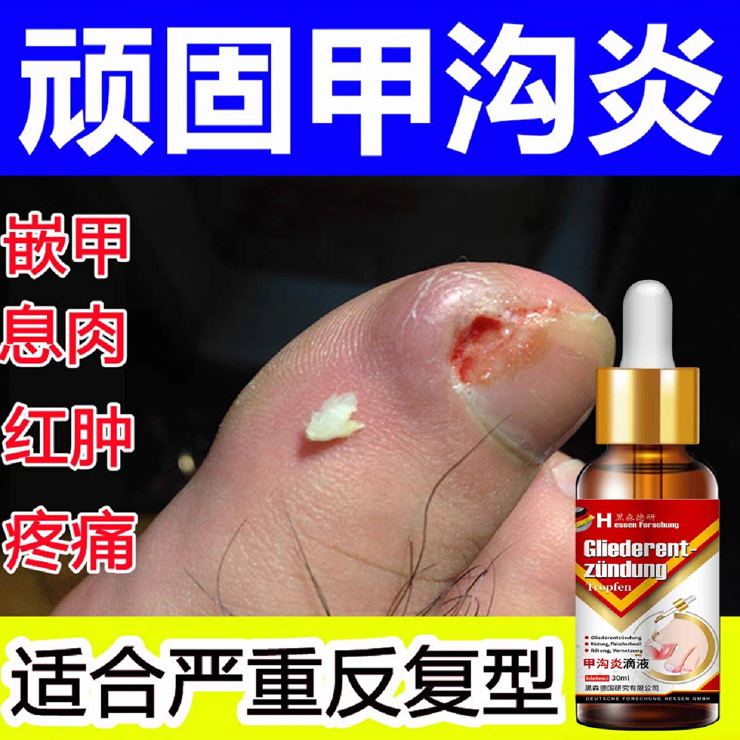 甲夹沟炎辅助治疗专用效特大药房器神脚趾根甲往肉里长手指膏嵌甲