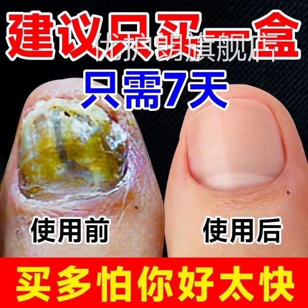 灰指甲修官复液脱甲膏去阿莫搽剂除增厚药水正品方旗舰店罗优护朗