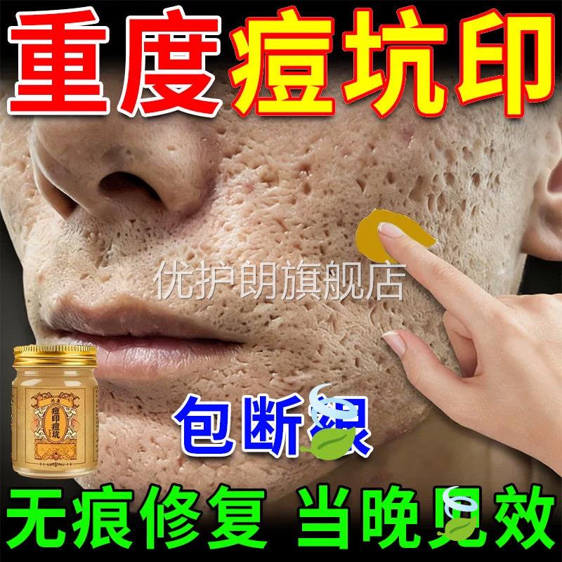 共康痘坑痘印护理膏修复凹洞淡化消填充再生祛i疤黑控油色素沉淀