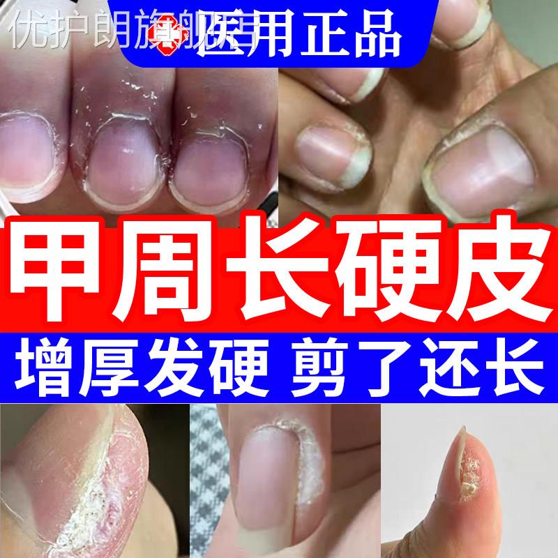软化甲周硬皮手指指甲边缘去死皮去手部角质老茧硬茧神器软化剂TT