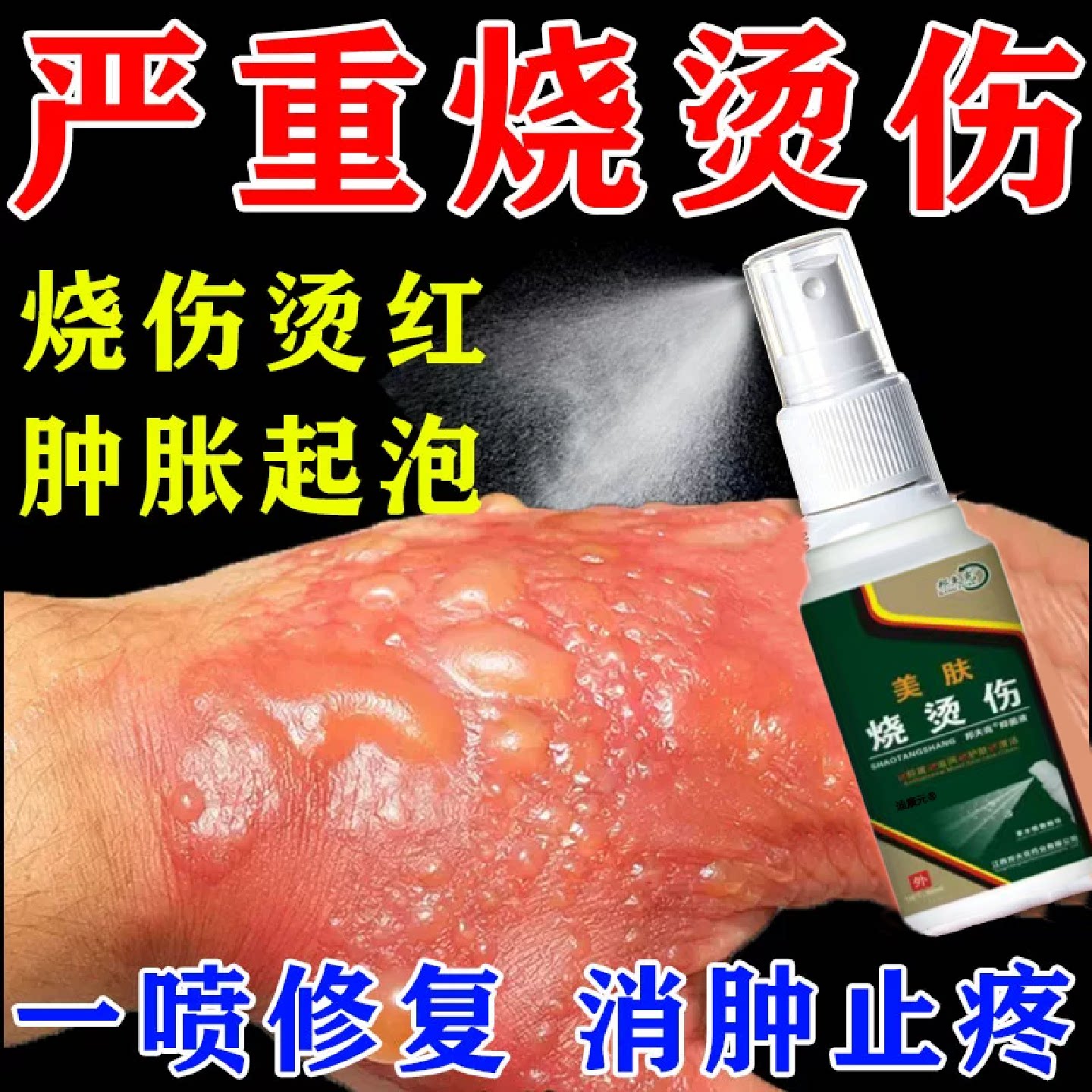 美肤烧烫伤喷雾烧伤水泡瘙痒红肿湿润降温修复皮肤伤口消炎止旗舰